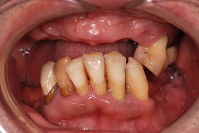 before １．重度の歯周病を<br>精密審美義歯・入れ歯にて修復