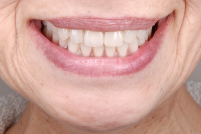 after ６．重度の歯周病を精密義歯にて修復