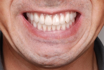 after ５．重度の歯周病と虫歯を、精密義歯修復にて修復