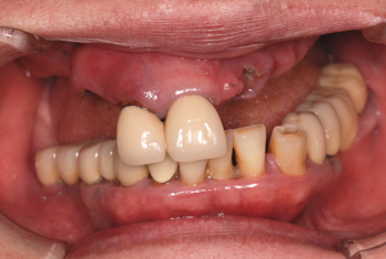 before ２．噛み合わせのズレと重度の虫歯を、精密審美義歯にて修復