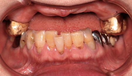 before ３．重度の歯周病と虫歯を、精密義歯及びセラミッククラウンにて修復