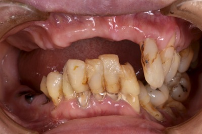 before １１．重度の歯周病を精密義歯にて、審美的によく噛めるように修復