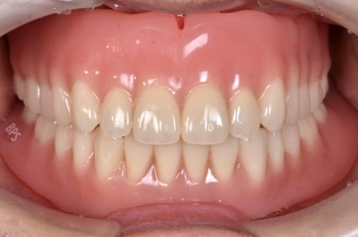 after １０．歯科恐怖症を伴う重度の歯周病を、精密義歯にて審美的に修復