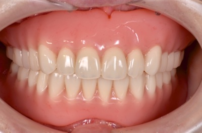 after １１．重度の歯周病を精密義歯にて、審美的によく噛めるように修復