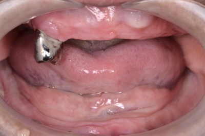 before １２．噛めない入れ歯をBPS精密義歯にて修復