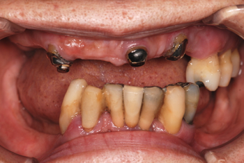 before ２０．部分入れ歯が歯周病によってグラグラして噛めない状態を、精密入れ歯にて修復