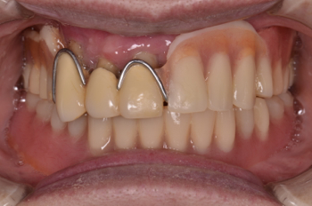 before １９．部分入れ歯が歯周病でグラグラして噛めない状態を、精密入れ歯にて修復