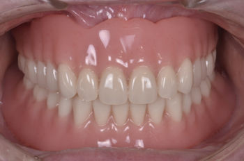 after １９．部分入れ歯が歯周病でグラグラして噛めない状態を、精密入れ歯にて修復