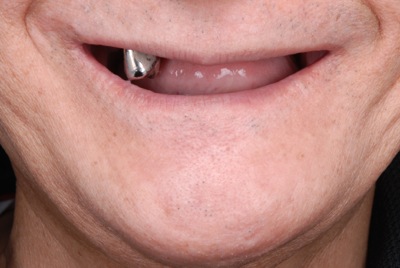 before １２．噛めない入れ歯をBPS精密義歯にて修復