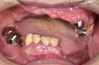 before １４．重度の歯周病で顎が強く吸収した状態を、精密義歯にて修復