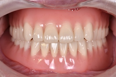 after １４．重度の歯周病で顎が強く吸収した状態を、精密義歯にて修復