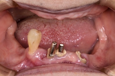 before ６．重度の歯周病を精密義歯にて修復
