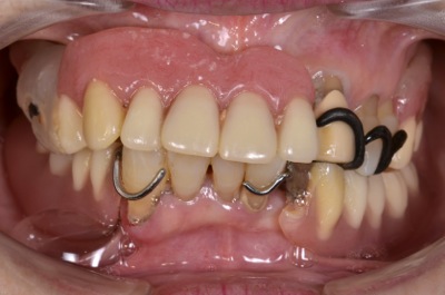 before ７．噛めない入れ歯を精密義歯にて修復