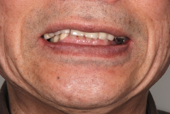 before １８．歯の破折やインプラント治療による噛み合わせのズレを、精密審美入れ歯にて修復した治療