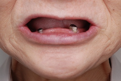 before ８．噛めない入れ歯とインプラントを、精密義歯にて修復