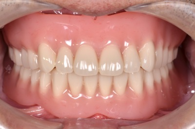 after ９．重度の歯周病を精密義歯にて修復