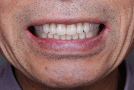 after １８．歯の破折やインプラント治療による噛み合わせのズレを、精密審美入れ歯にて修復した治療