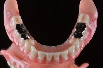 after ２．噛み合わせのズレと重度の虫歯を、精密審美義歯にて修復
