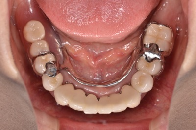 after １５．重度の歯周病を精密義歯修復　及びセラミック、精密部分入れ歯にて審美的に修復