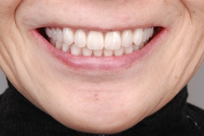after ８．噛めない入れ歯とインプラントを、精密義歯にて修復
