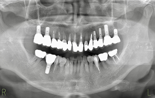 after ８オールセラミッククラウン及び、インプラントの治療例