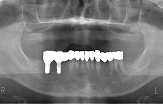 after ９上顎を総入れ歯、下顎をインプラントおよびオールセラミック治療で修復した治療例