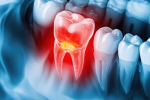 虫歯を放置して炎症を起こした歯茎