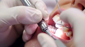 根管治療のイメージ