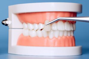 セラミック治療をする歯のイメージ