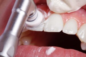 歯周病予防に歯科でクリーニングをするイメージ