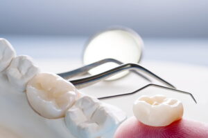 奥歯をセラミックにする治療の様子