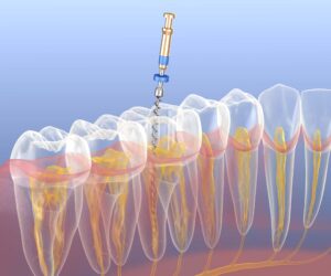 根管治療のイメージ