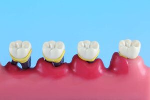 歯周病が進行する様子