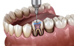 根管治療の様子