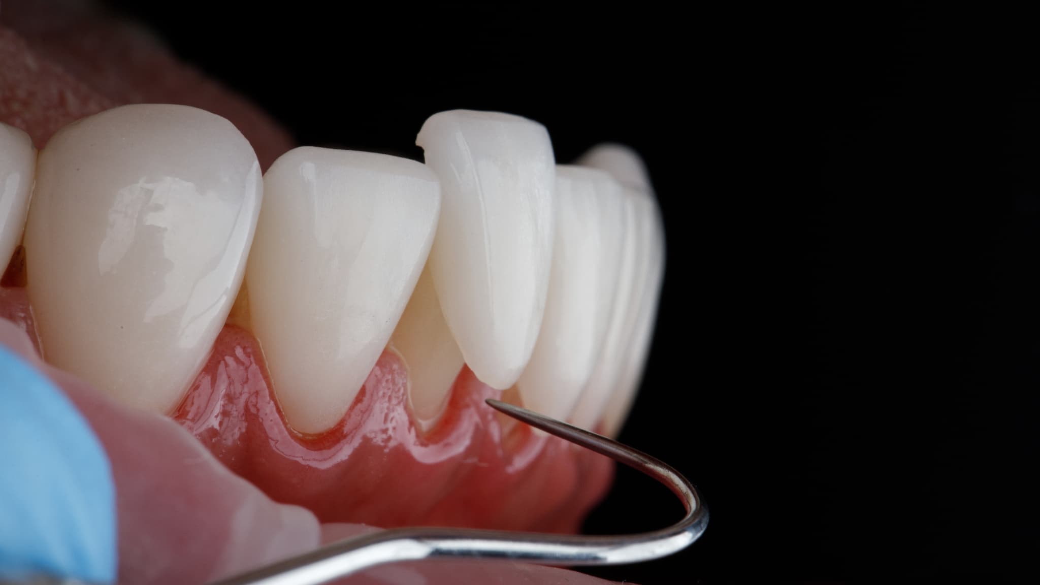 セラミックの歯を入れたあとに口臭がする原因イメージ