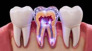 再感染した歯の神経のイメージ
