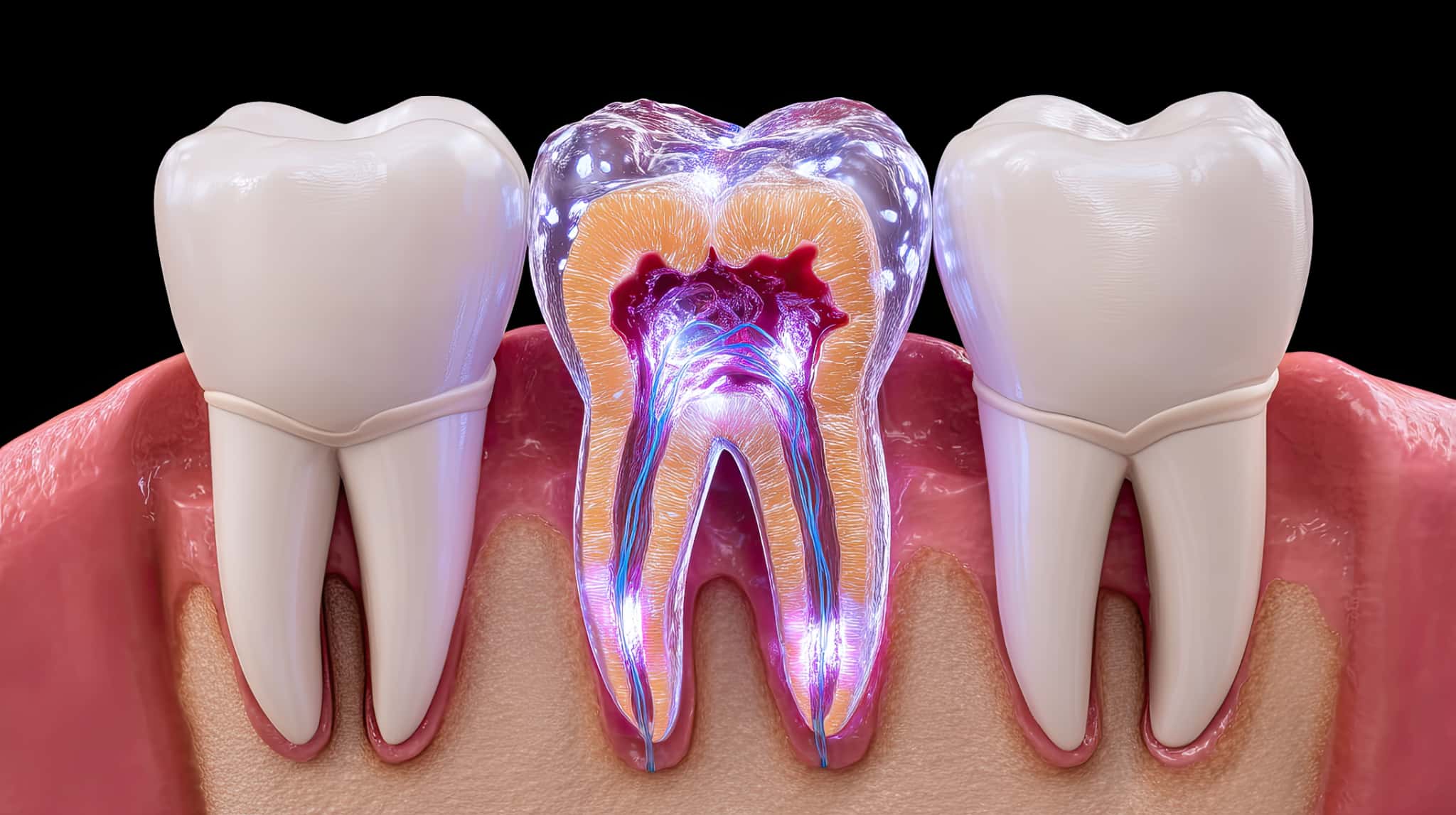 再感染した歯の神経のイメージ