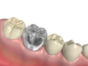 銀歯のイメージ