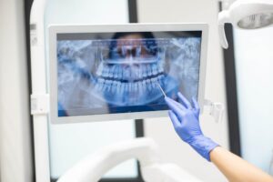 レントゲンで歯周病の進行状況を確認する様子