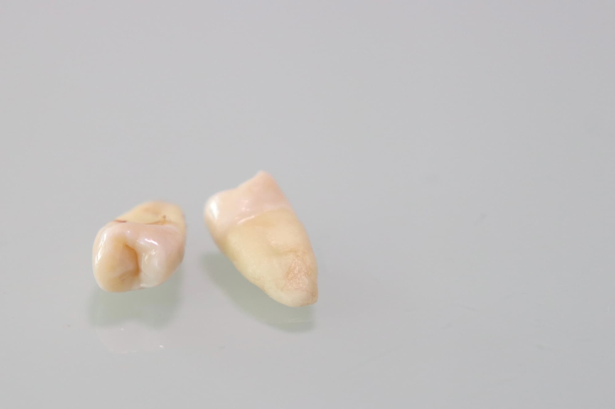 歯周病の悪化によって抜けた歯