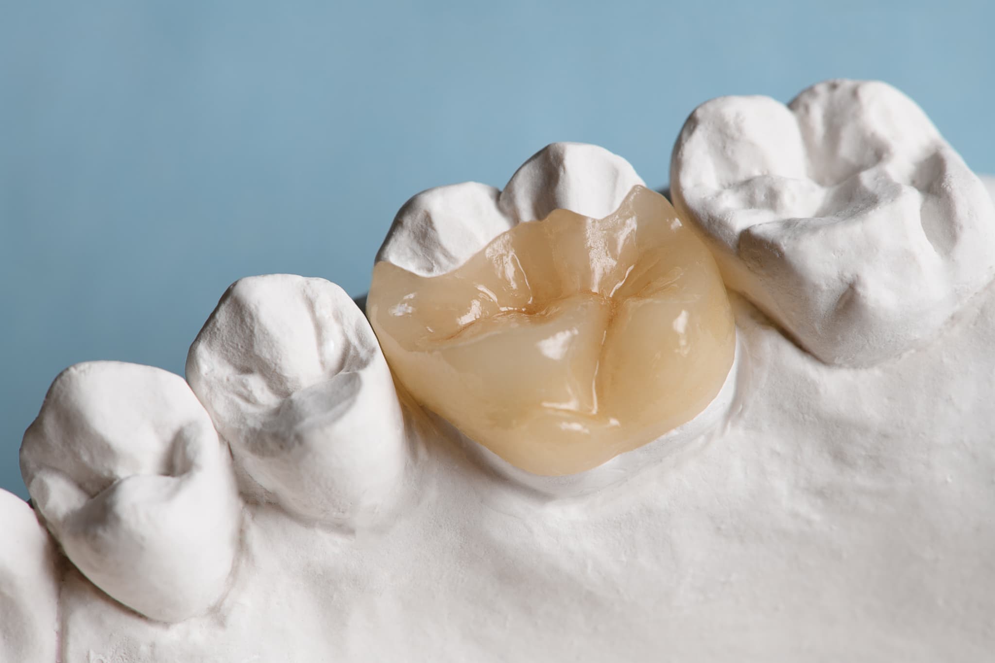 セラミックの詰め物