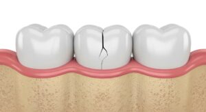 破損したセラミックの歯