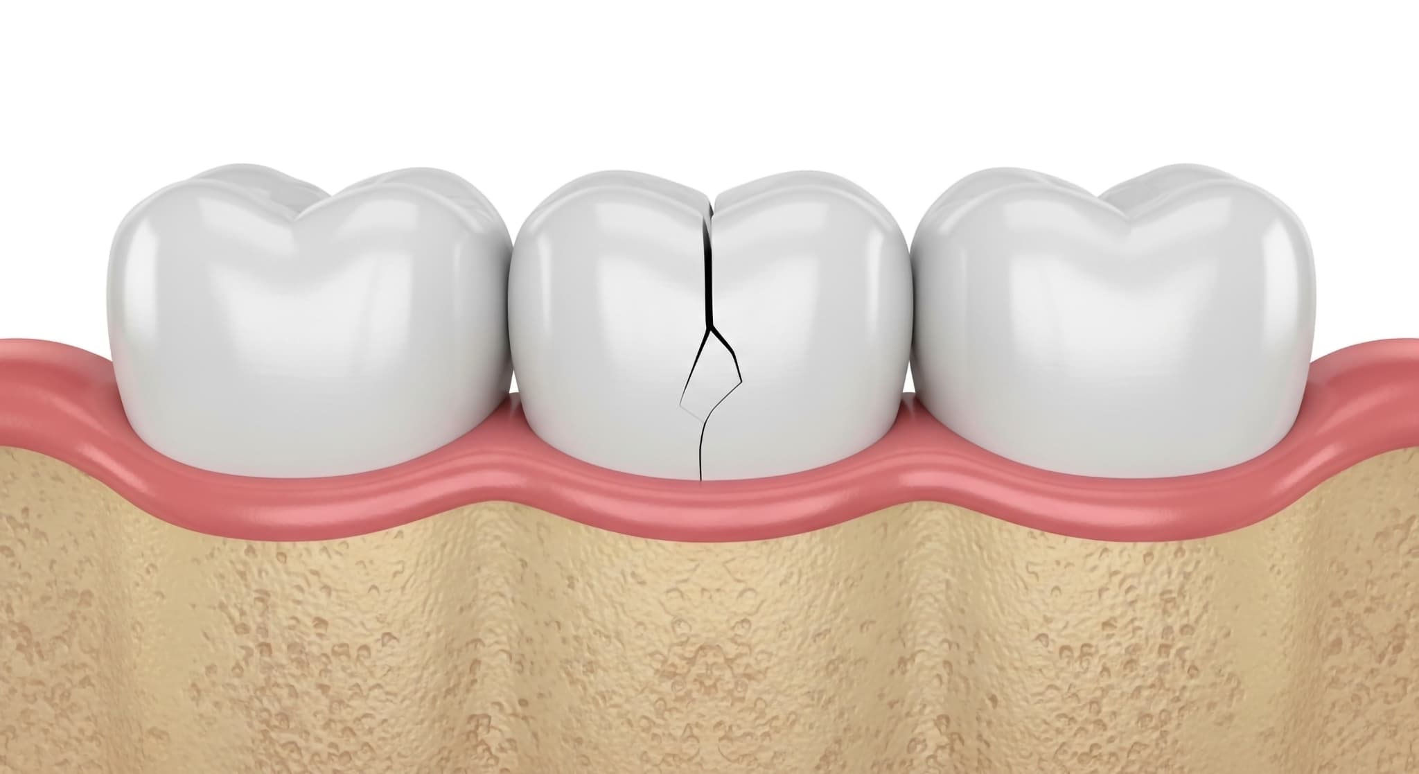 破損したセラミックの歯