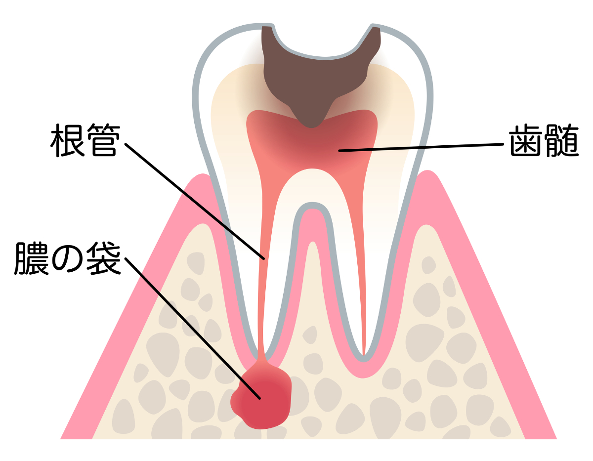 歯の根の先の膿イメージ