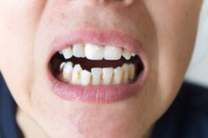 虫歯になりやすい人の特徴である歯並びの悪さ